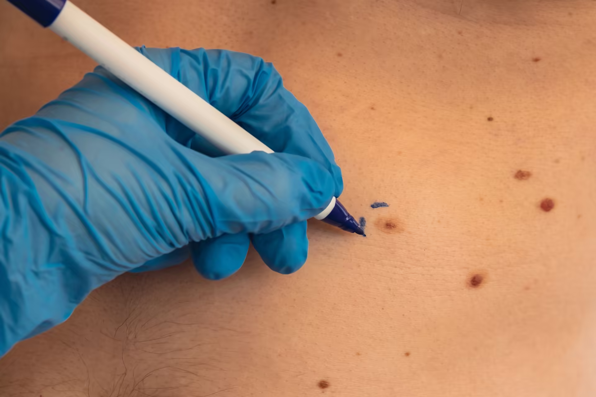 Dermatologista de luvas marcando com caneta cirúrgica uma lesão nas costas de um paciente.